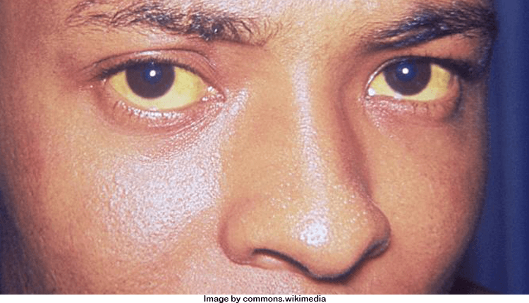 Home Remedies For Jaundice In Adults