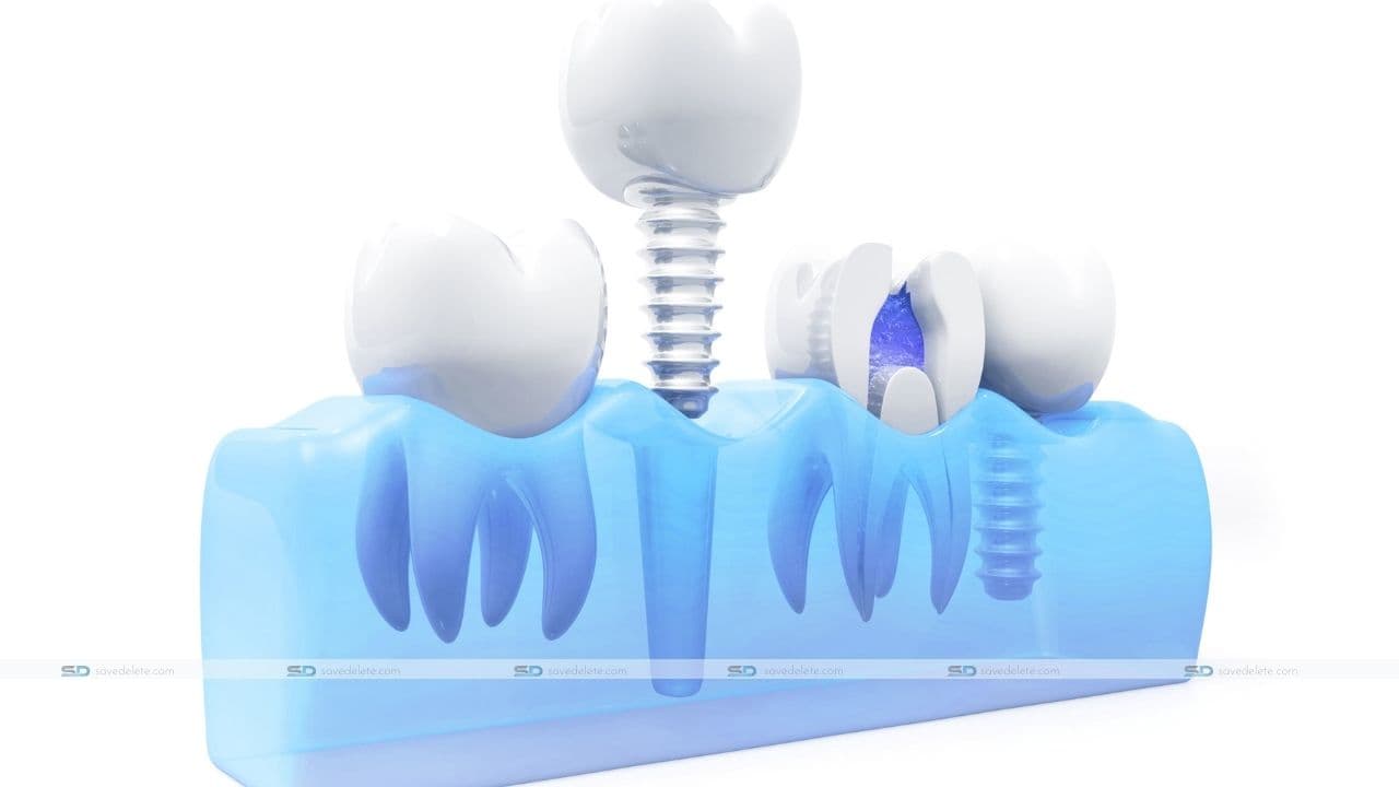 7 Reasons People Choose Dental Implants Over Dentures