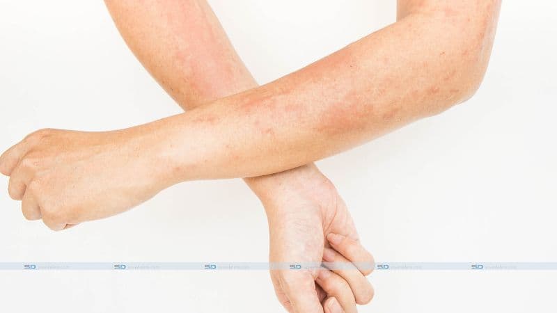 Recurrent fungal infections of the skin: Causes and treatment