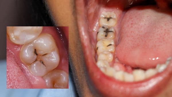 Cavity Catastrophe: How to Stop Decay Before It Starts!