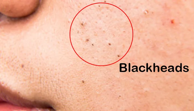 How to Remove the Blackheads Effectively?