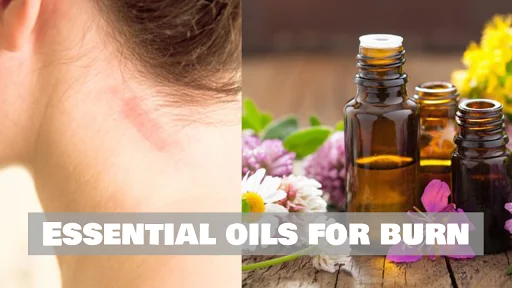 Top 5 Essential Oils For Burn