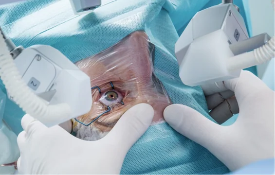 How Does Lasik Surgery Work?
