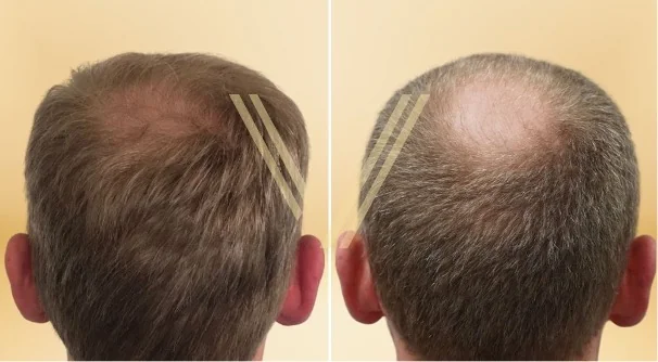 Envisioning Your Hair Transplant