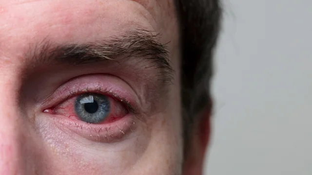 Fast and Effective: How to Fix Pink Eye in Record Time!