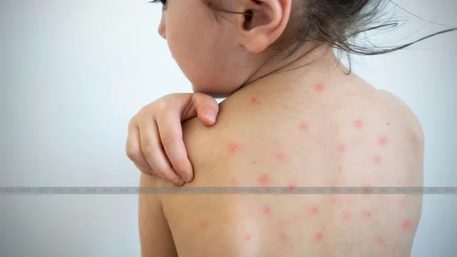 Caring for a Child with Chickenpox