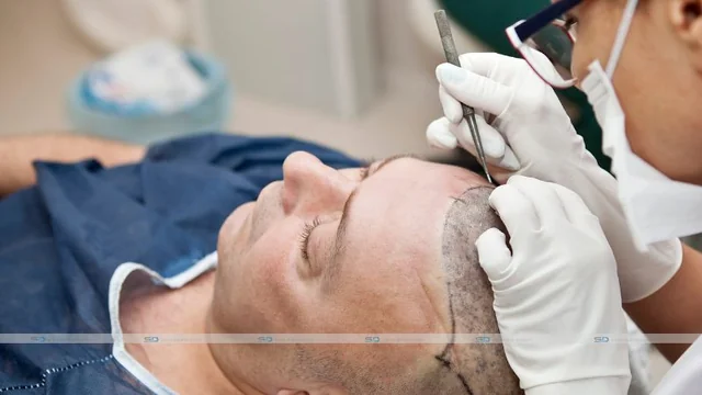 What to Expect During Hair Transplant Recovery Timeline in Sydney