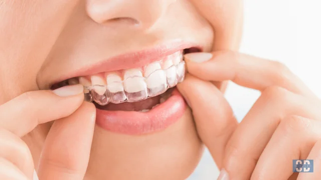 Top 7 Reasons Adults Are Choosing Invisalign Over Braces