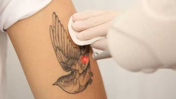 tattoo being removed with a laser