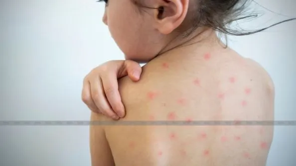 Chickenpox